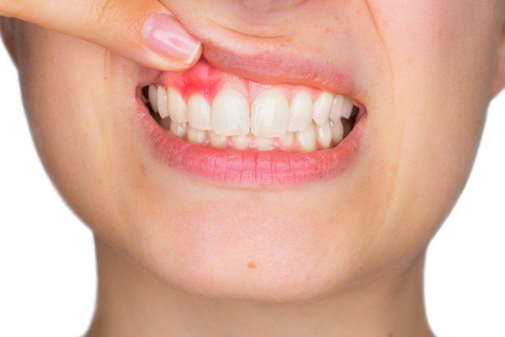 woman with gum disease